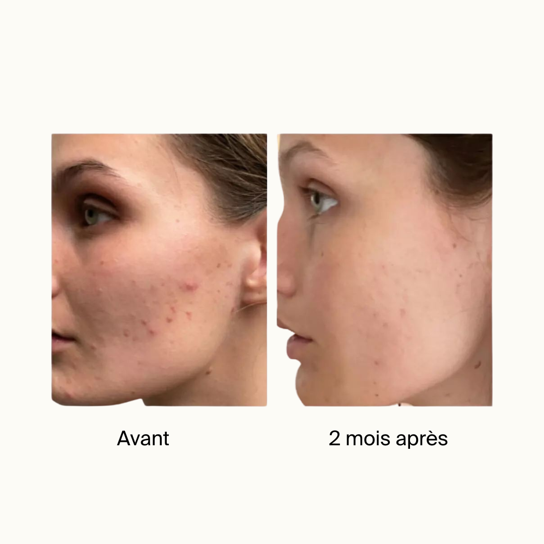 Anti-Imperfection Face Serum 2% BHA